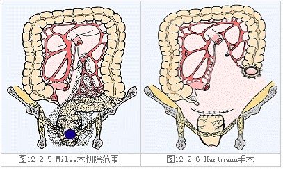 直肠癌病人到底怎么排便? - 科学松鼠会 - 科学松鼠会
