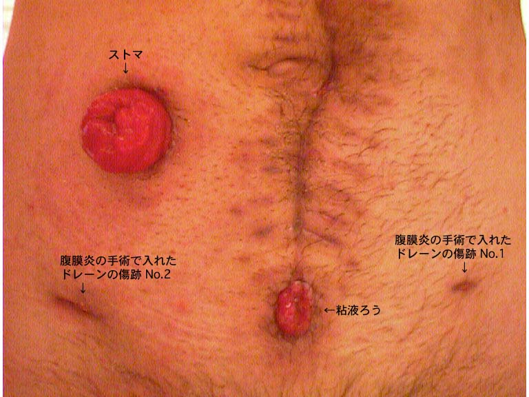 直肠癌病人到底怎么排便? - 科学松鼠会 - 科学松鼠会