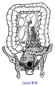 其中常用的一种术式就是dixon手术——即切 除病变的直肠,清扫周围的
