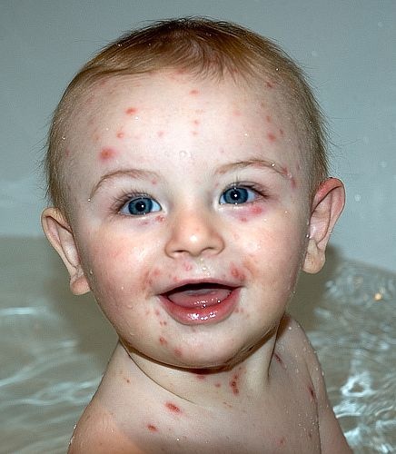 北京进入水痘高发期，家长注意预防宝宝感染水痘