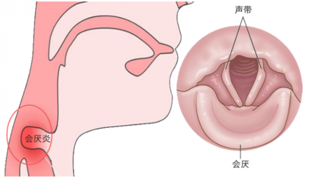 会厌炎真的那么可怕吗？