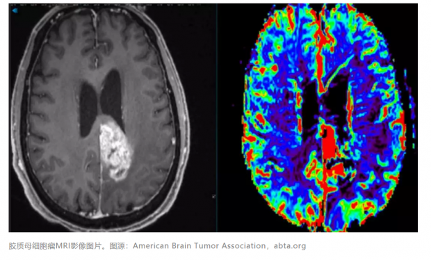 脑部肿瘤为何易复发？科学家刨根问底