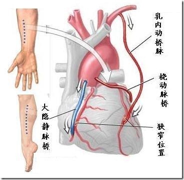 心脏搭桥图片 示意图图片