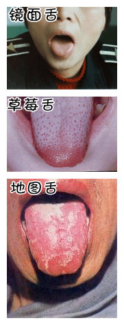 舌头梅毒图片