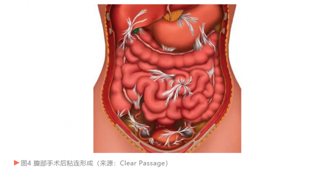 剖腹产后子宫粘连图片图片